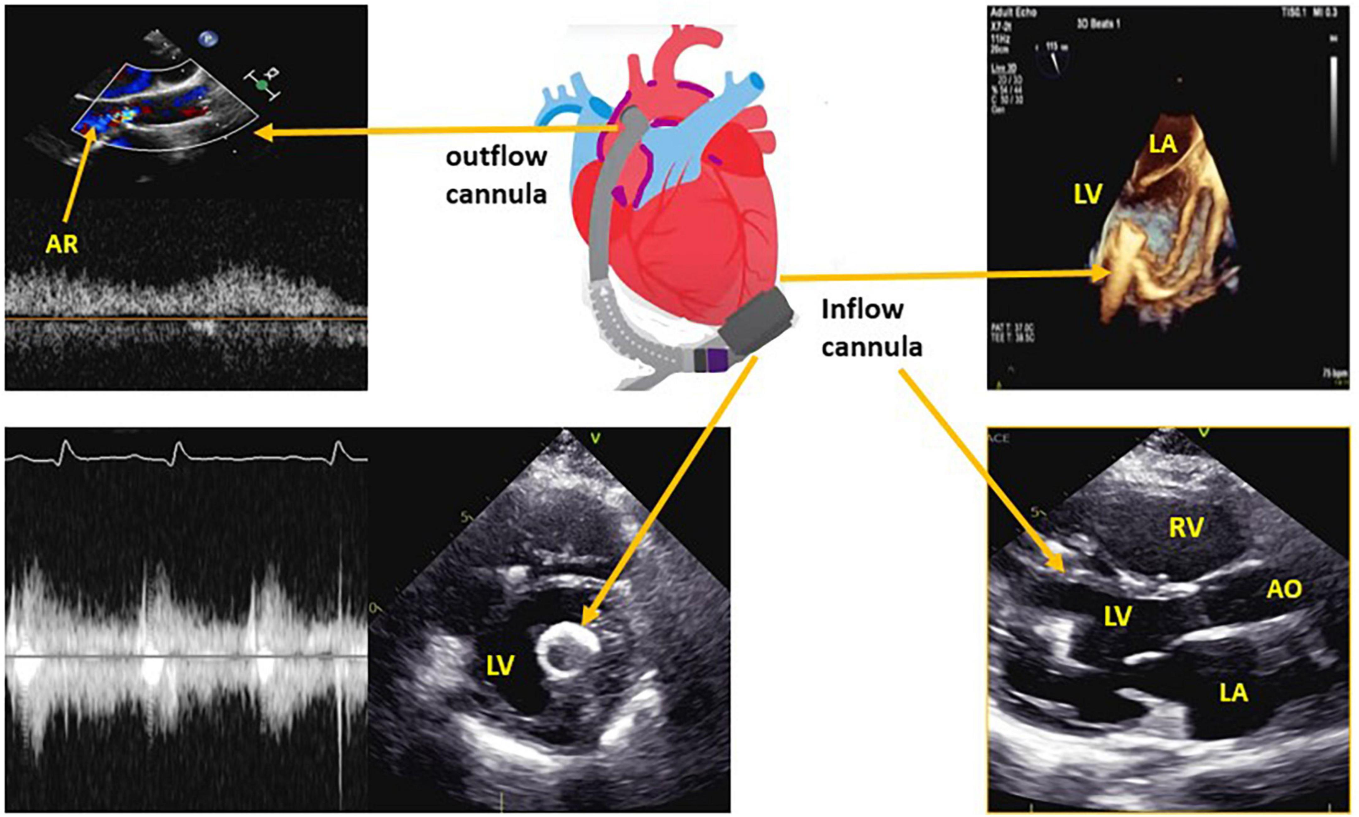 Reciprocal interferences of the left ventricular assist device and the aortic valve competence